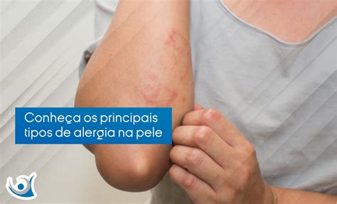 tipos de alergias de pele